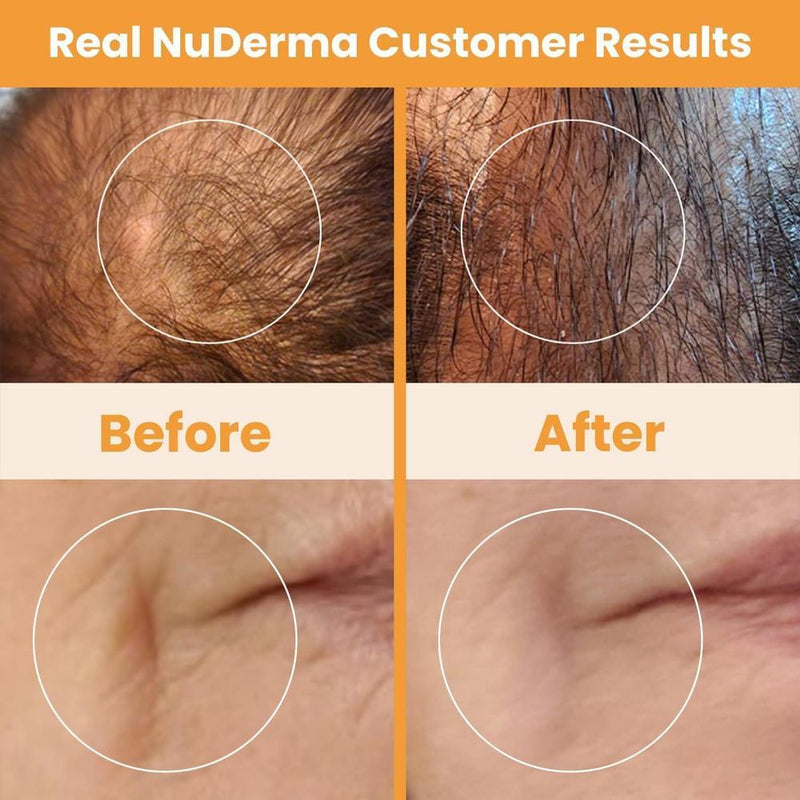 NuDerma - Máquina portátil de terapia de piel con aplicadores de neón, antienvejecimiento y estimulador de cabello y cuero cabelludo
