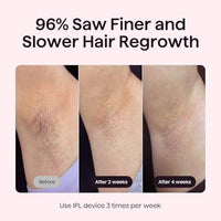 Wavytalk IPL Hair Removal Device, Bare It for Face Body Bikini – Long-Lasting Result & Painless,Full Body in 12 Mins with 24J Dual-Pulse & Ice Cooling, At-Home Use for Women and Men, Corded, Pink