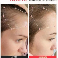 iRestore Sistema profesional de terapia láser de luz roja iRestore para el crecimiento del cabello - Autorizado por la FDA para el tratamiento de la pérdida de cabello, adelgazamiento del cabello y alopecia