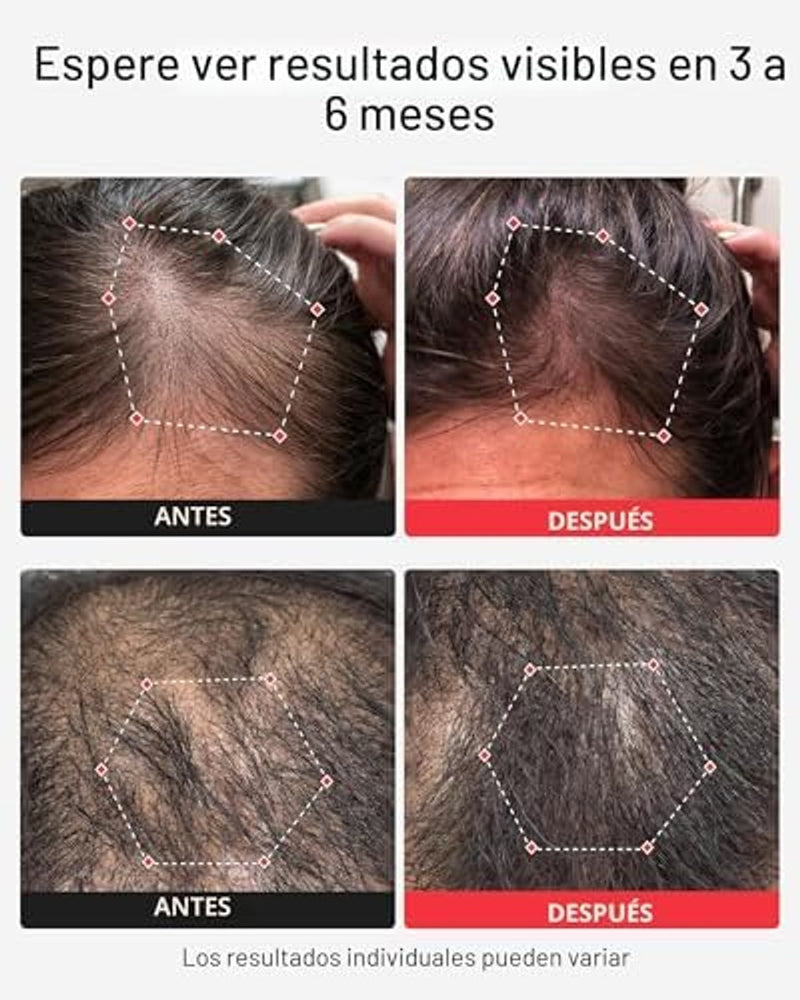 iRestore Sistema profesional de terapia láser de luz roja iRestore para el crecimiento del cabello - Autorizado por la FDA para el tratamiento de la pérdida de cabello, adelgazamiento del cabello y alopecia
