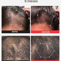iRestore Sistema profesional de terapia láser de luz roja iRestore para el crecimiento del cabello - Autorizado por la FDA para el tratamiento de la pérdida de cabello, adelgazamiento del cabello y alopecia
