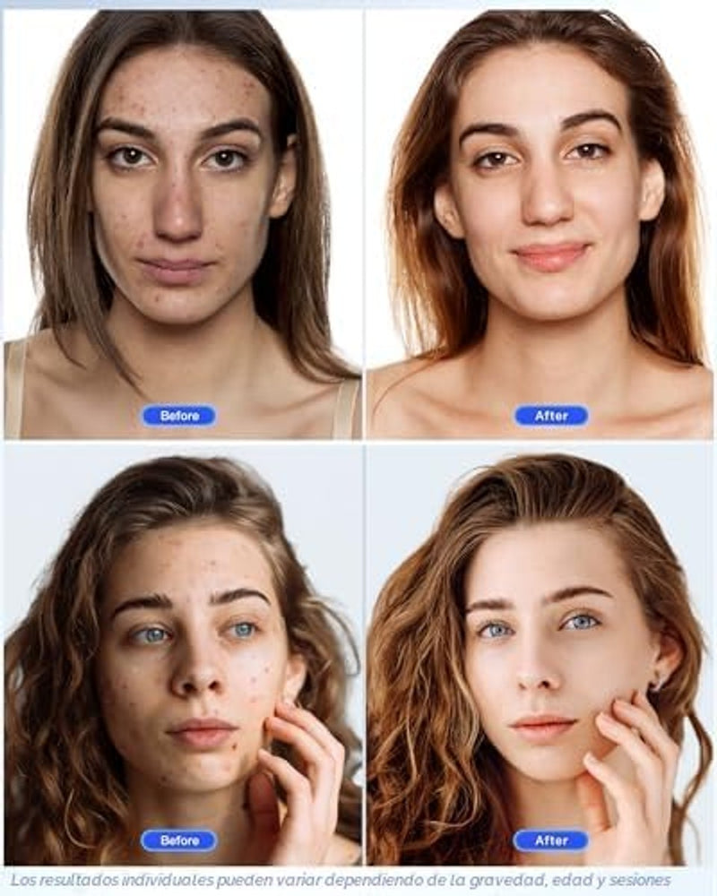 NEWKEY Sistema de terapia de fotones Newkey de luz LED, en 7 colores, para el cuidado de la piel facial y máscara de belleza