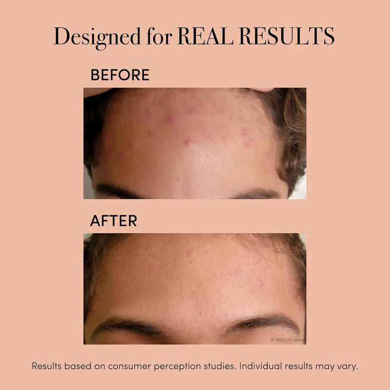 ReVive - Dispositivo clínico para acné, varita de luz roja y azul para brotes, herramientas de acné autorizadas por la FDA, herramientas faciales de 3 minutos para cuidado de la piel, diseño enchufabl
