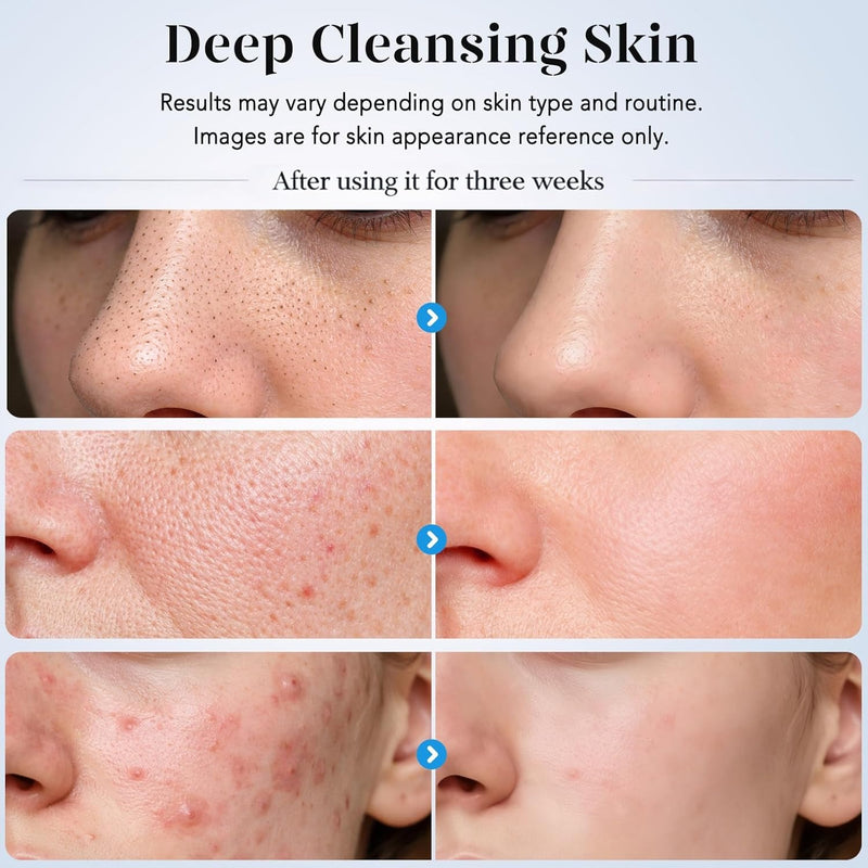 GUGUG - Espátula para exfoliar la piel, espátula facial, limpiador de poros, herramientas removedoras de puntos negros con 4 modos para limpieza profunda facial - Blanco