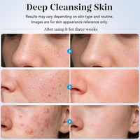 GUGUG - Espátula para exfoliar la piel, espátula facial, limpiador de poros, herramientas removedoras de puntos negros con 4 modos para limpieza profunda facial - Blanco