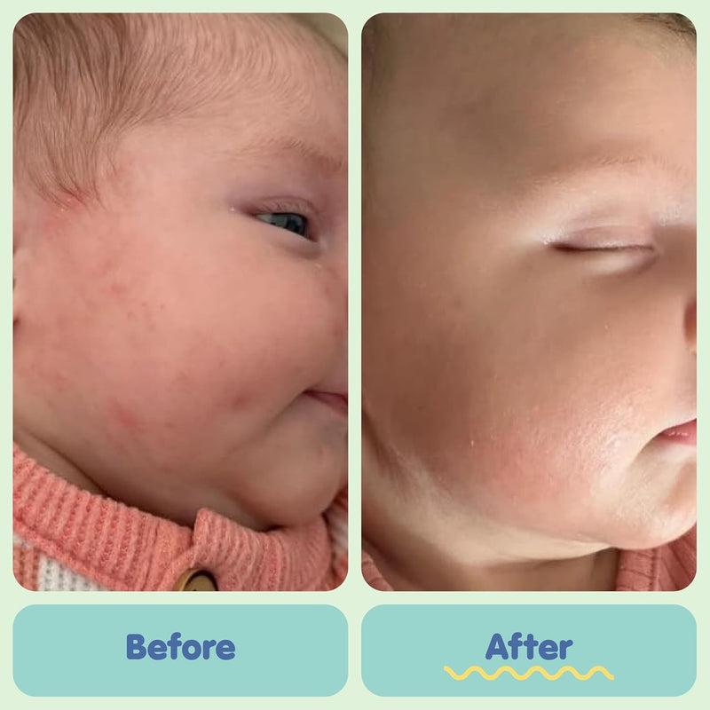 TUBBY TODD All Over Ungüento - Crema para eccema para bebé, multiuso diario, sensible, seca, irritación, crema para aliviar la piel del bebé, sin esteroides y gluten, sin fragancia, 1 paquete, 8 onzas