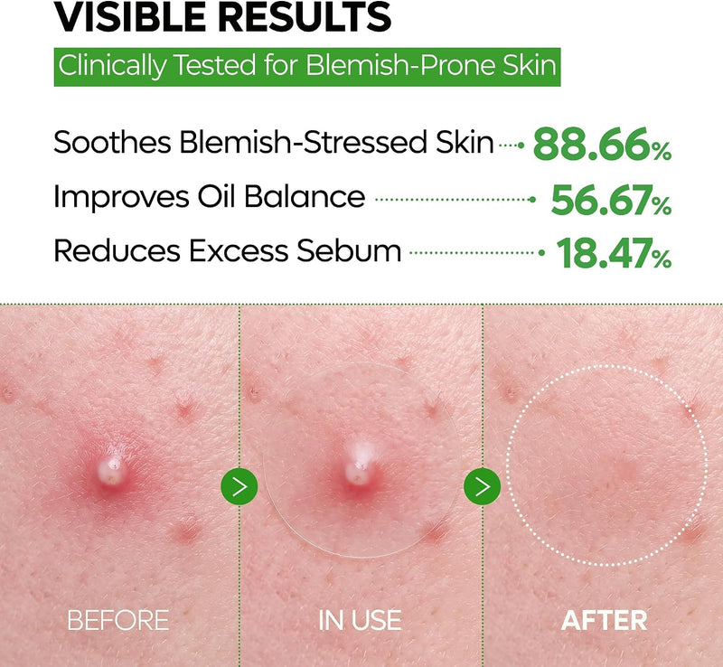 Dr.Melaxin S-ZINC ZERO-FIT Ultra Thin Blemish Spot Patch 0.013mm Invisible Pimple Stickers with Sulfur, Salicylic Acid, AHA & PHA, Seamless Under Makeup Face Cover, 12mm x 72 Patches