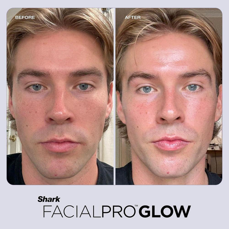 Shark FacialPro Glow Sistema facial en casa con tecnología avanzada y terapia DePuffi para limpieza e hidratación de la piel