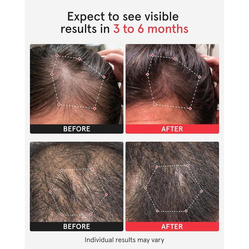 Sistema de terapia láser iRestore para el crecimiento del cabello, autorizado por FDA para calvicie y alopecia