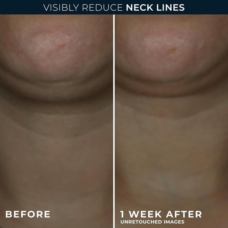 Roc Derm Correxion Crema Para El Cuello Con Ácido Hialurónico Y Retinol Avanzado 50g