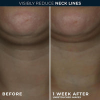 Roc Derm Correxion Crema Para El Cuello Con Ácido Hialurónico Y Retinol Avanzado 50g