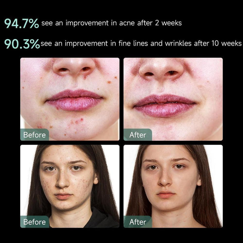 Aphrona Máscara facial LED aprobada por la FDA para reducción de arrugas y eliminación de acné con terapia de luz roja y azul