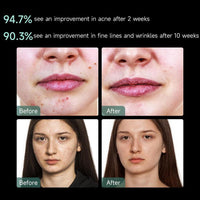 Aphrona Máscara facial LED aprobada por la FDA para reducción de arrugas y eliminación de acné con terapia de luz roja y azul