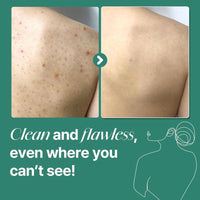 SOME BY MI AHA BHA PHA Miracle Limpiador Antiacné Cuerpo con Árbol de Té y Ácido Salicílico, Limpieza Profunda