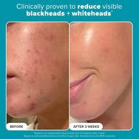 Paula's Choice Exfoliante 2% BHA Ácido Salicílico 118ml