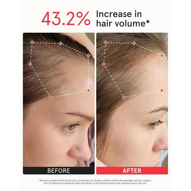 Sistema de terapia láser iRestore para el crecimiento del cabello, autorizado por FDA para calvicie y alopecia