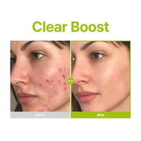 Purito Serum Facial Acido Azelaico 10% Acido Kojico Arbol De Te 30ml