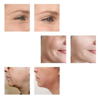 Máquina facial de estiramiento mediante radiofrecuencia, masajeador antienvejecimiento y dispositivo deshinchador ocular