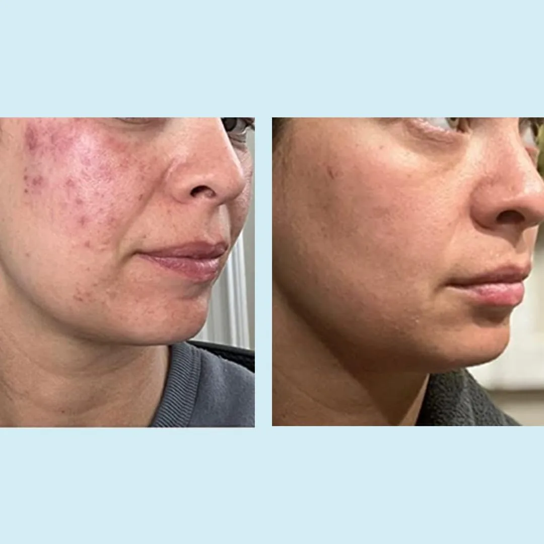 Glycolic Acid 50% Gel Peel - Enhanced with Retinol & Green Tea Extract (Professional Skin Peel)1 ounce