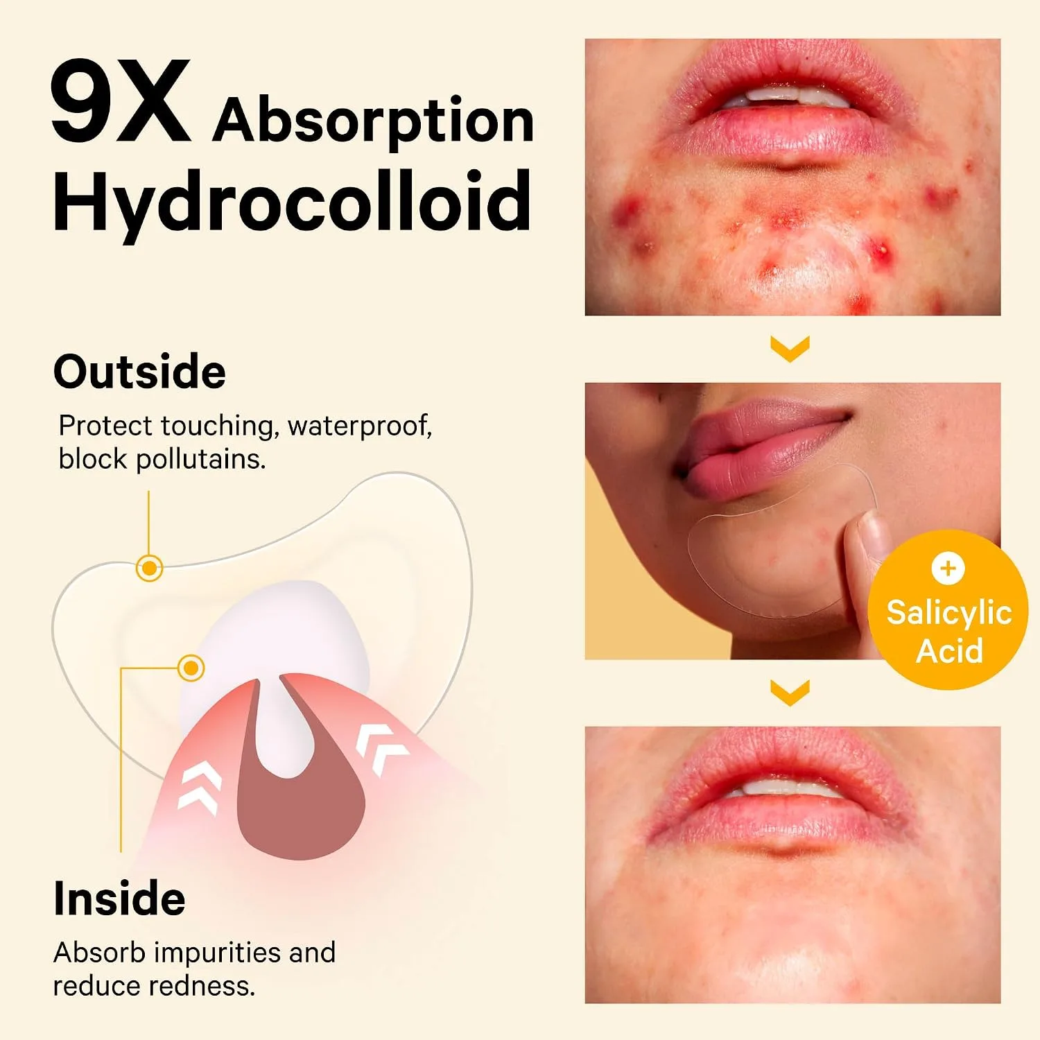 Sosky Chin Pimple Patches Hydrocolloid Acne Patches for Breakouts Large Spot Control Covers for Face Chin & Body Vegan Cruelty Free (12 Count)