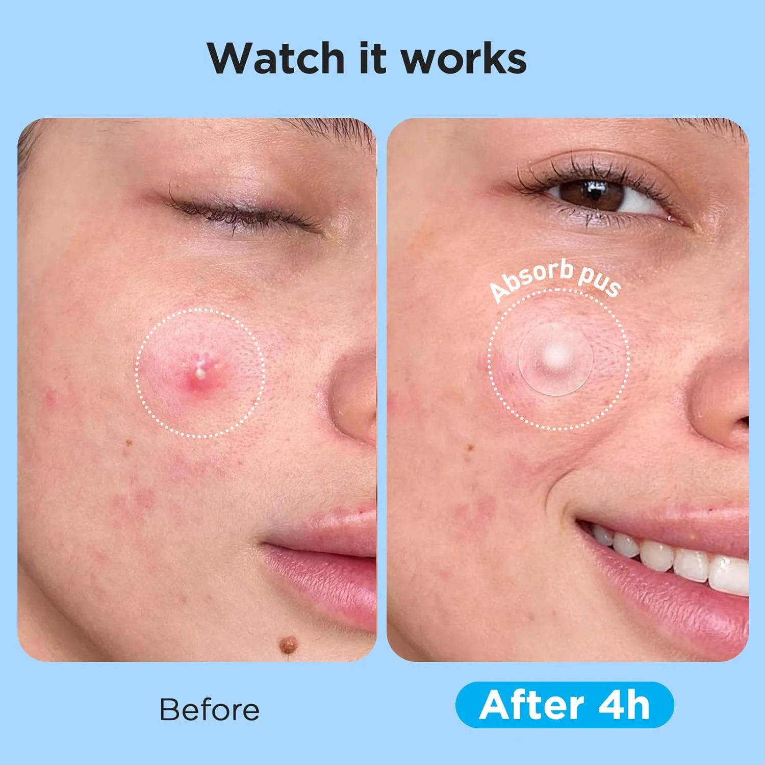504 Counts 4 Sizes Hydrocolloid Pimple Patches for Face