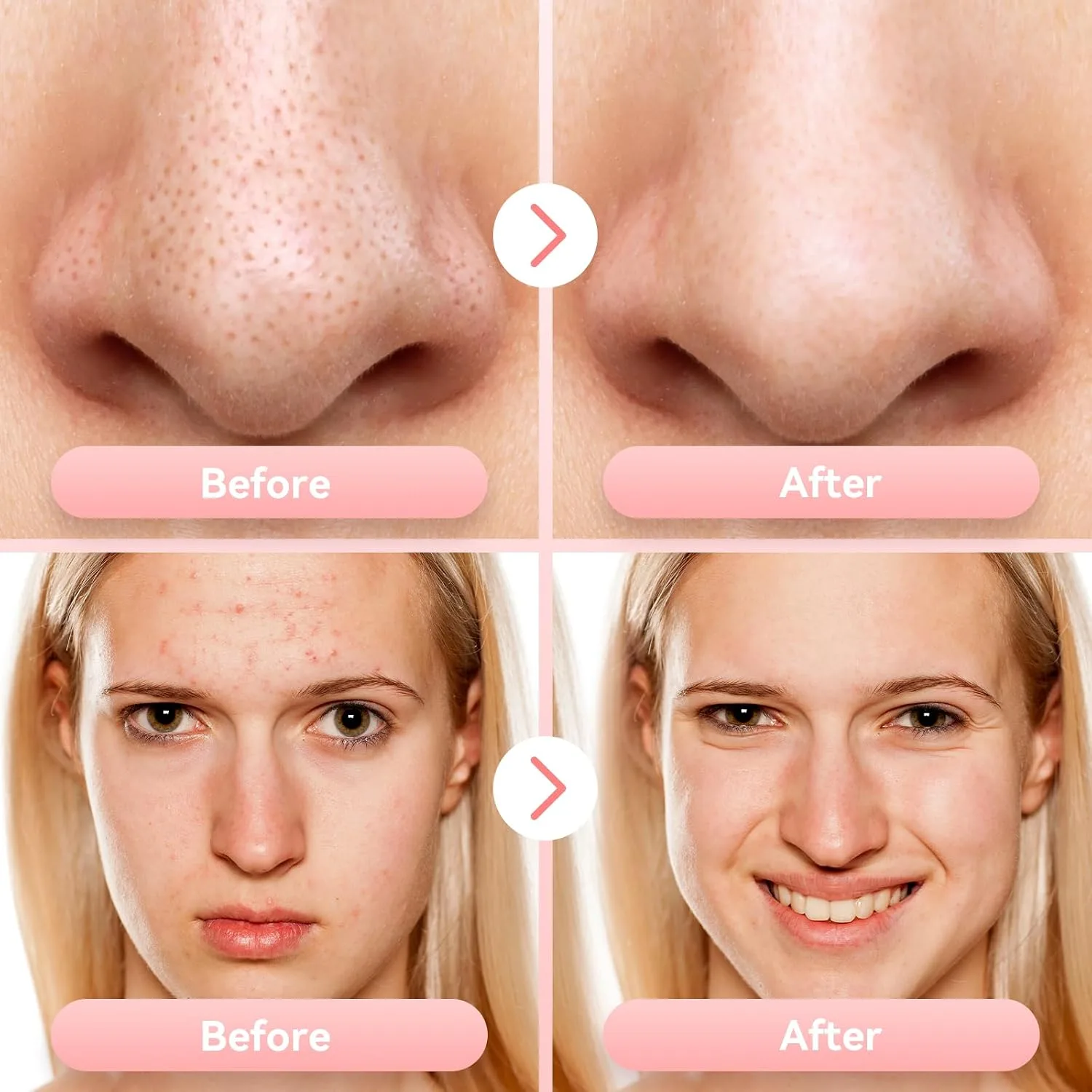 Blackhead Remover Vacuum, Facial Pore Extractor, 5 Suction Levels, 5 Probes