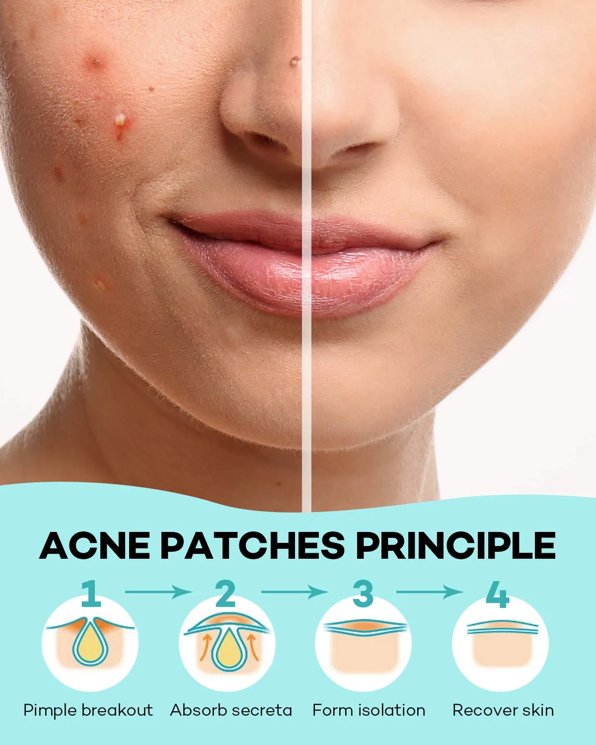 TKTK Pimple Patch Acne Patch, 4 Sizes 140 Patches FSA Acne Absorbing Cover Patch, Hydrocolloid Invisible Acne Patches for Face Zit Patch Acne Dots Tea Tree, Calendula Oil