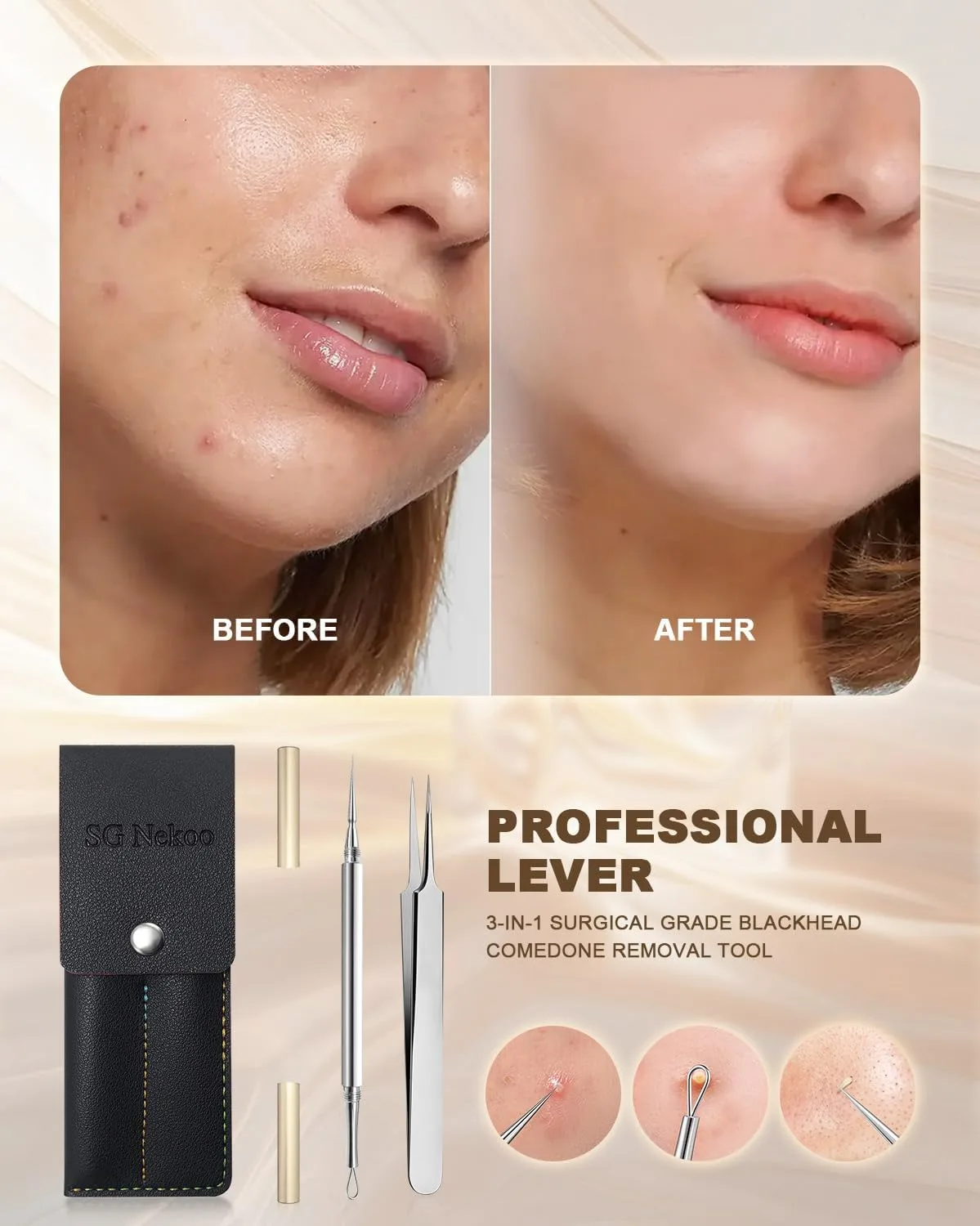 SGNEKOO Professional Facial Milia Removal Tool and Whitehead Extractor