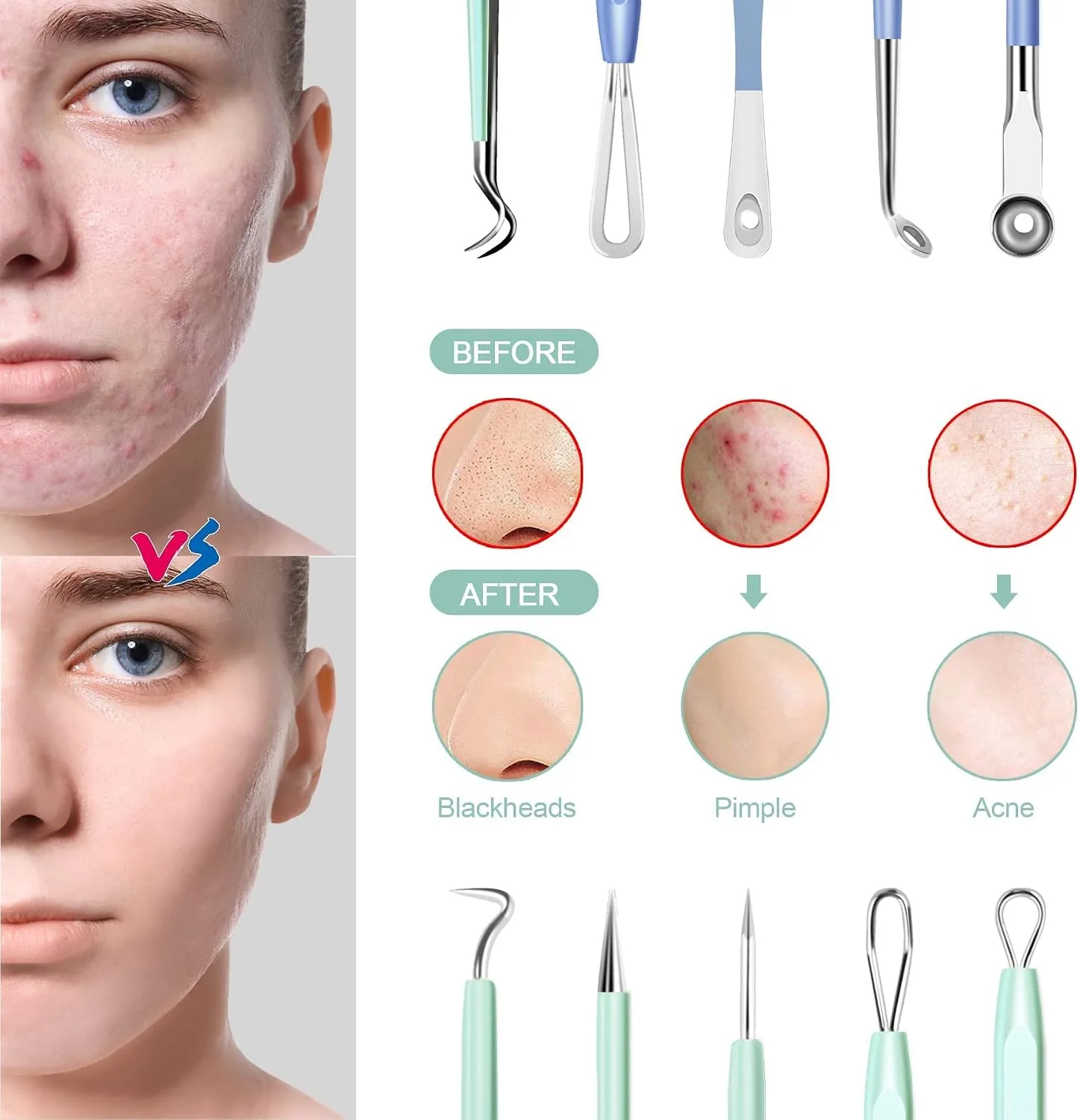 MENOLY Blackhead Remover Tools 10Pcs Pimple Popper Tool Kit, Blackhead Remover Extractor Tools, Anti-Slip Handle Pimple Comedone Extractor Acne Kit for Blackhead,Blemish,Zit Whitehead