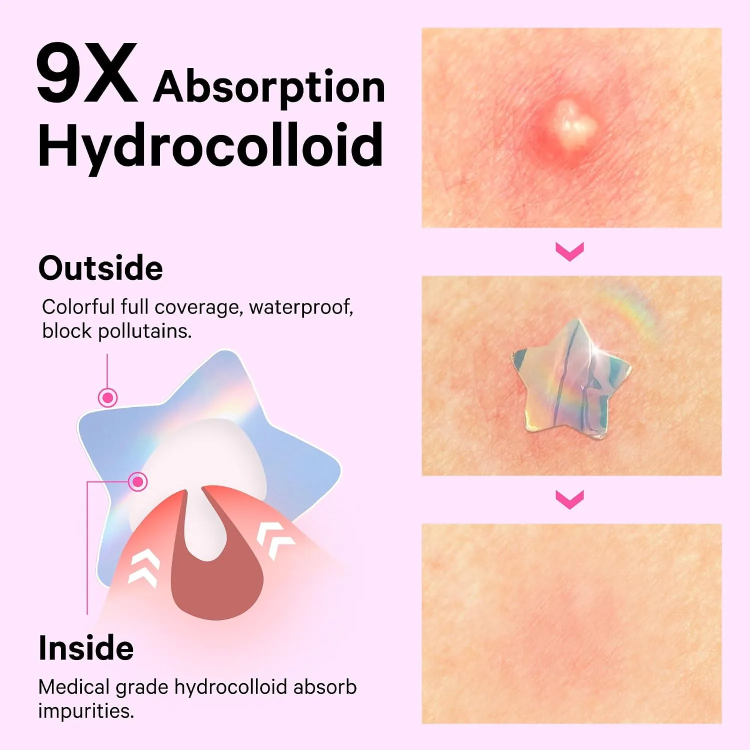 Sosky Hologram Pimple Patches for Face, Hydrocolloid Acne Patches with Salicylic Acid, Cute Star Zit Stickers,Colorful Blemish Covers,48 Count Pink Heart Flower