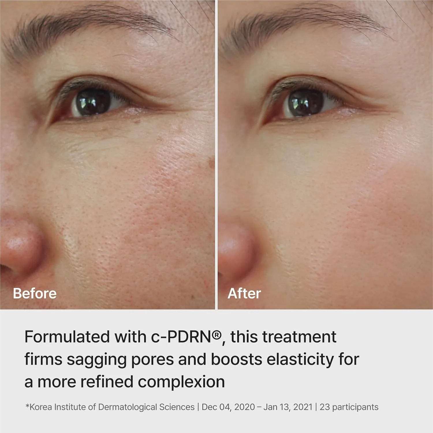 REJURAN Ampoule Infused Lifting Mask, DOT™ c-PDRN® Hydrogel, 4 Count