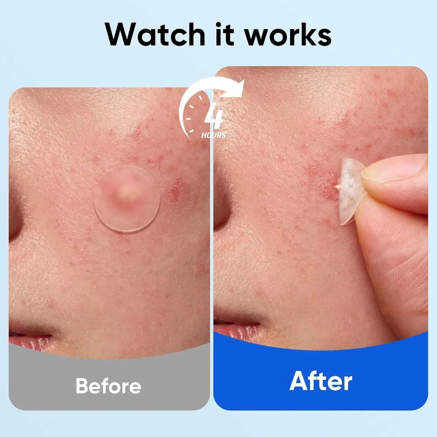 Daolyo 661 Count Pimple Patches - Hydrocolloid Acne Patches for Face & Body