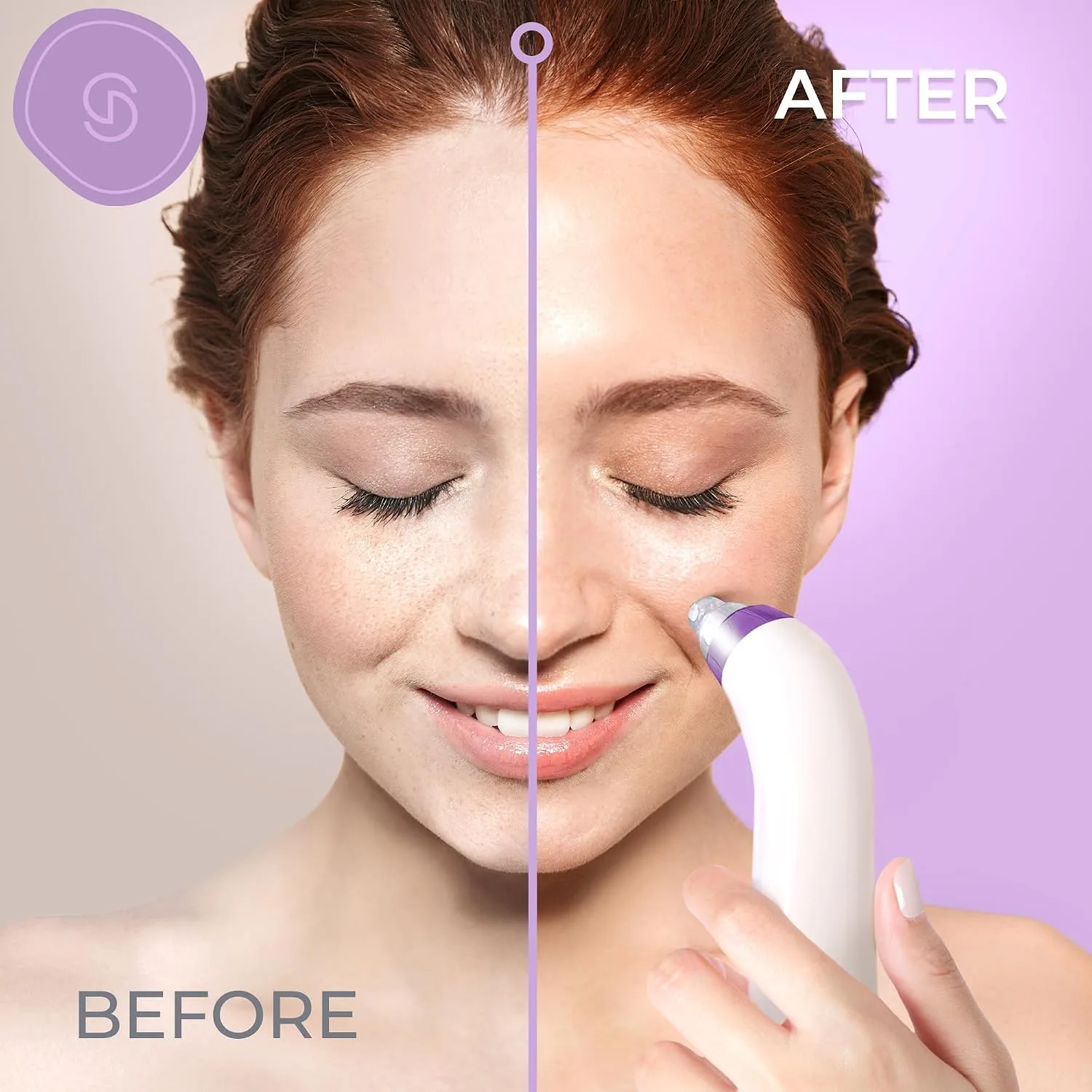 Essy Blackhead Remover Facial Cleanser Machine for Pimple Suction (Purple)