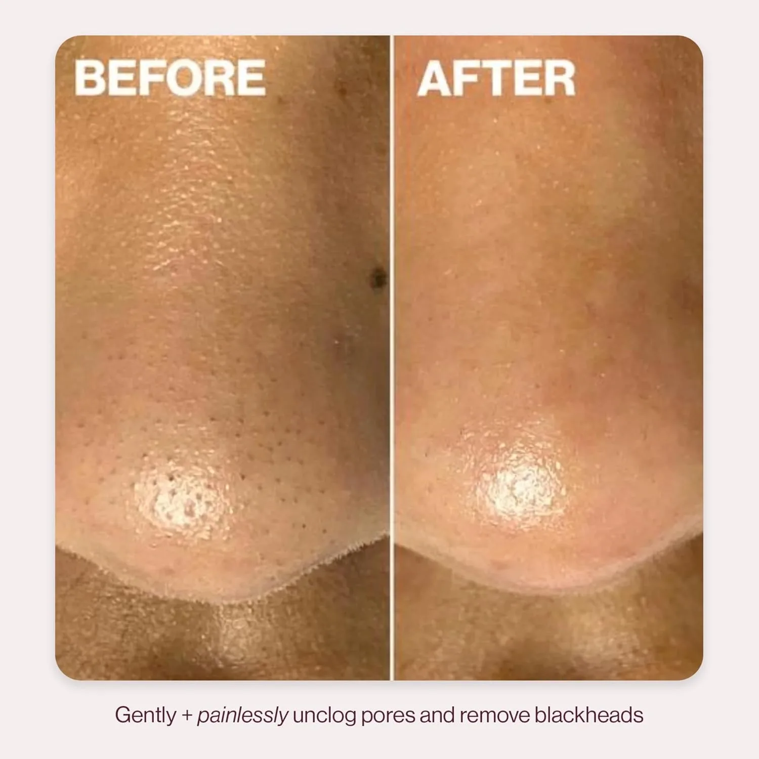 DERMAFLASH DERMAPORE+ Skin Care Device, Ultrasonic 2-in-1 Pore Extractor and Skincare Infuser, Blush