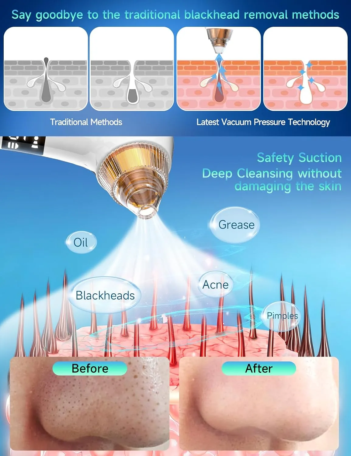 Upgraded Visible Blackhead Remover Pore Vacuum,5 Suction Levels,6 Probes