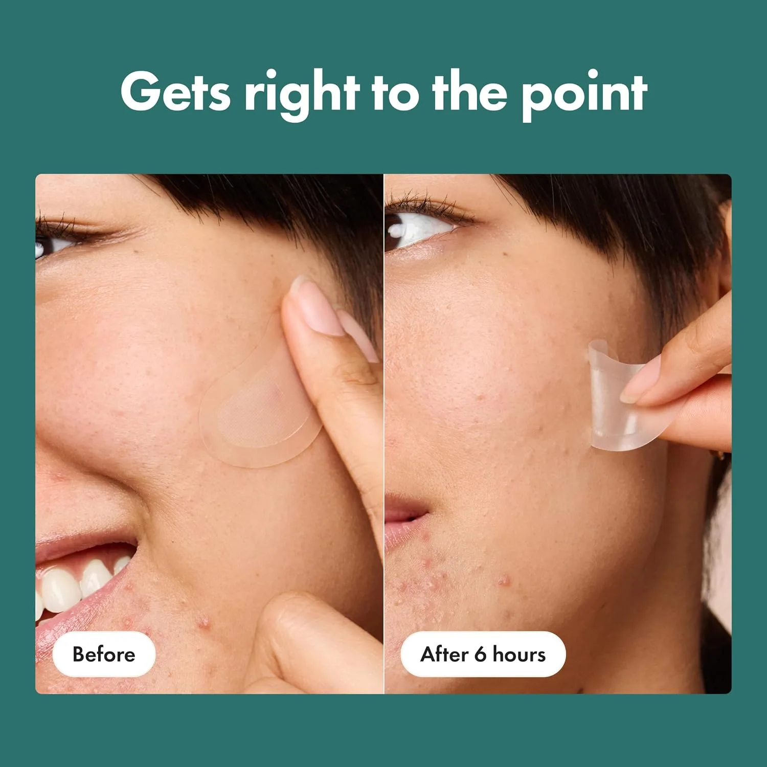 Mighty Patch Hero Cosmetics Micropoint XL Acne Pimple Patches, 6 Ct