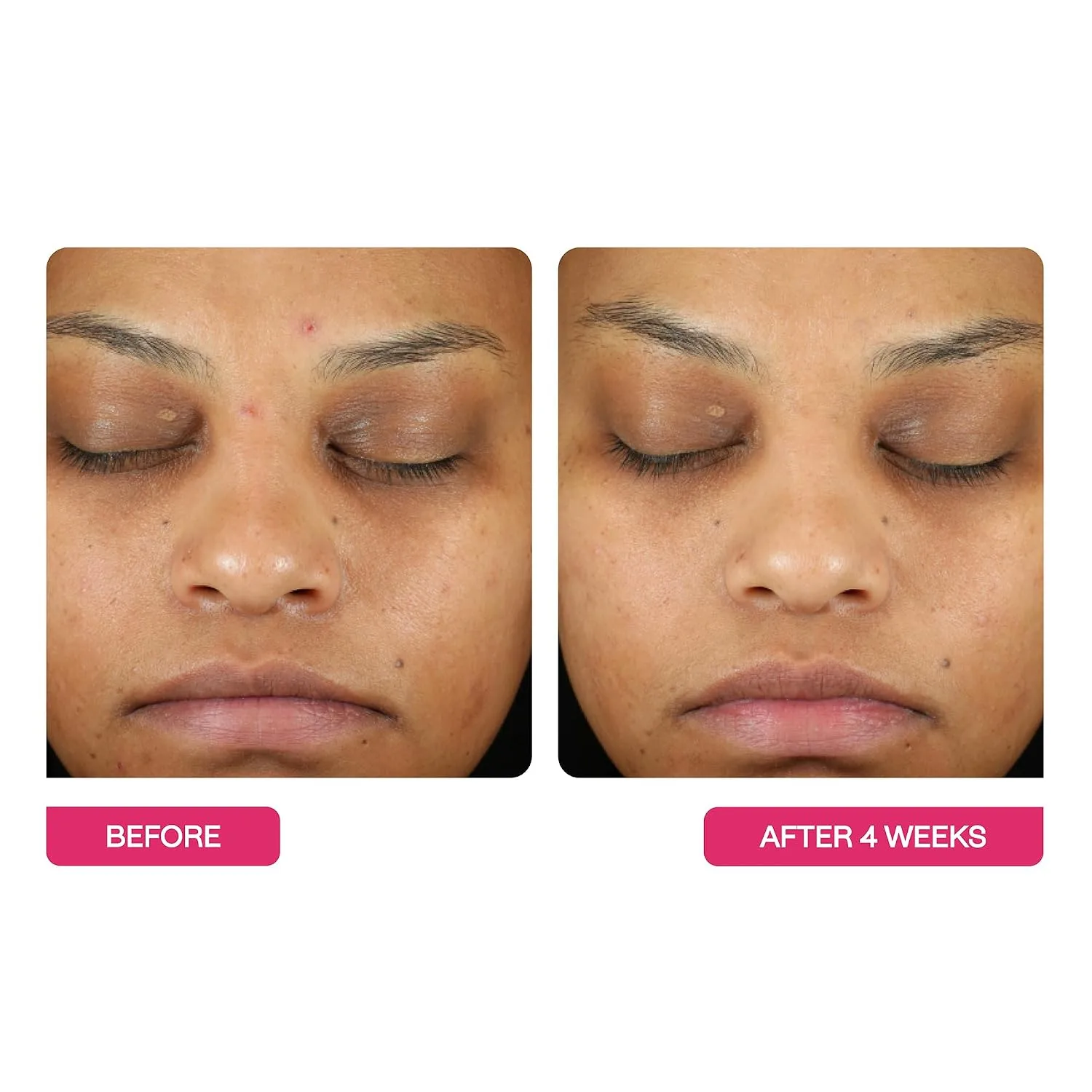 BeautyStat Exfoliating Peel Pads - AHA BHA Chemical Peel for Face