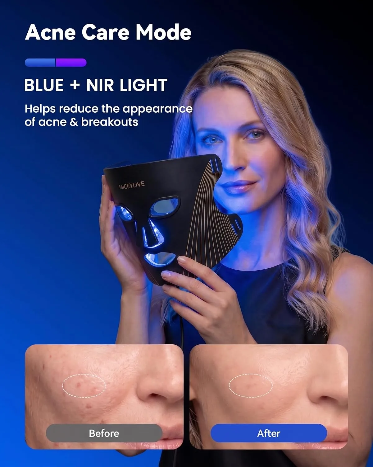 FDA-Cleared Blue Light Therapy for Acne with Mild-to-Moderate Inflammation