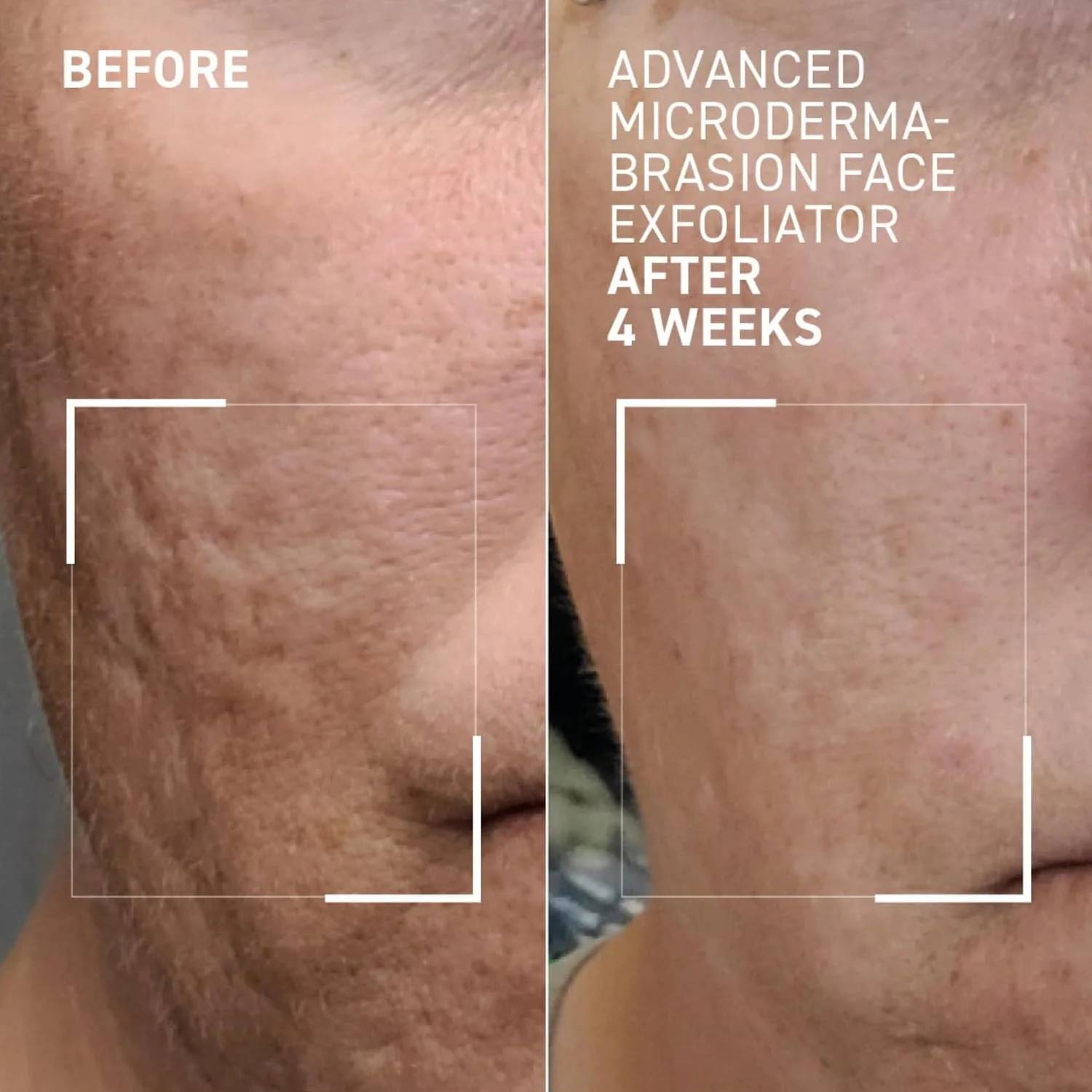 Dr. Brandt Advanced Microdermabrasion Face Exfoliator - 2.1 oz