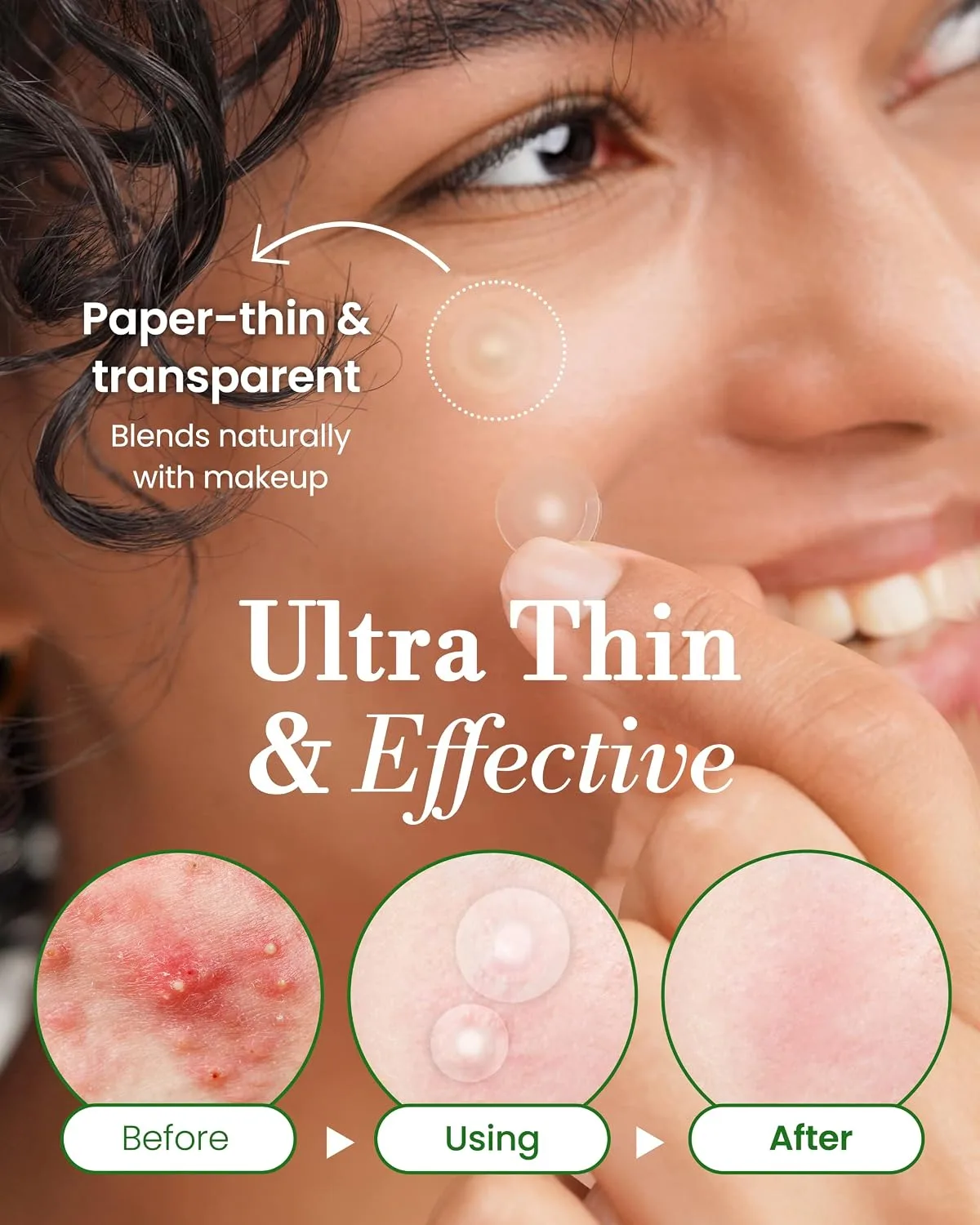 Troubless Invisible Pimple Spot Patch - Classic, Hydrocolloid Acne Patches for Face | Ultra Thin Acne Patches with Easy Peel Handle | Overnight Pimple Patches | 2 Sizes, 96 Count (Pack of 1)