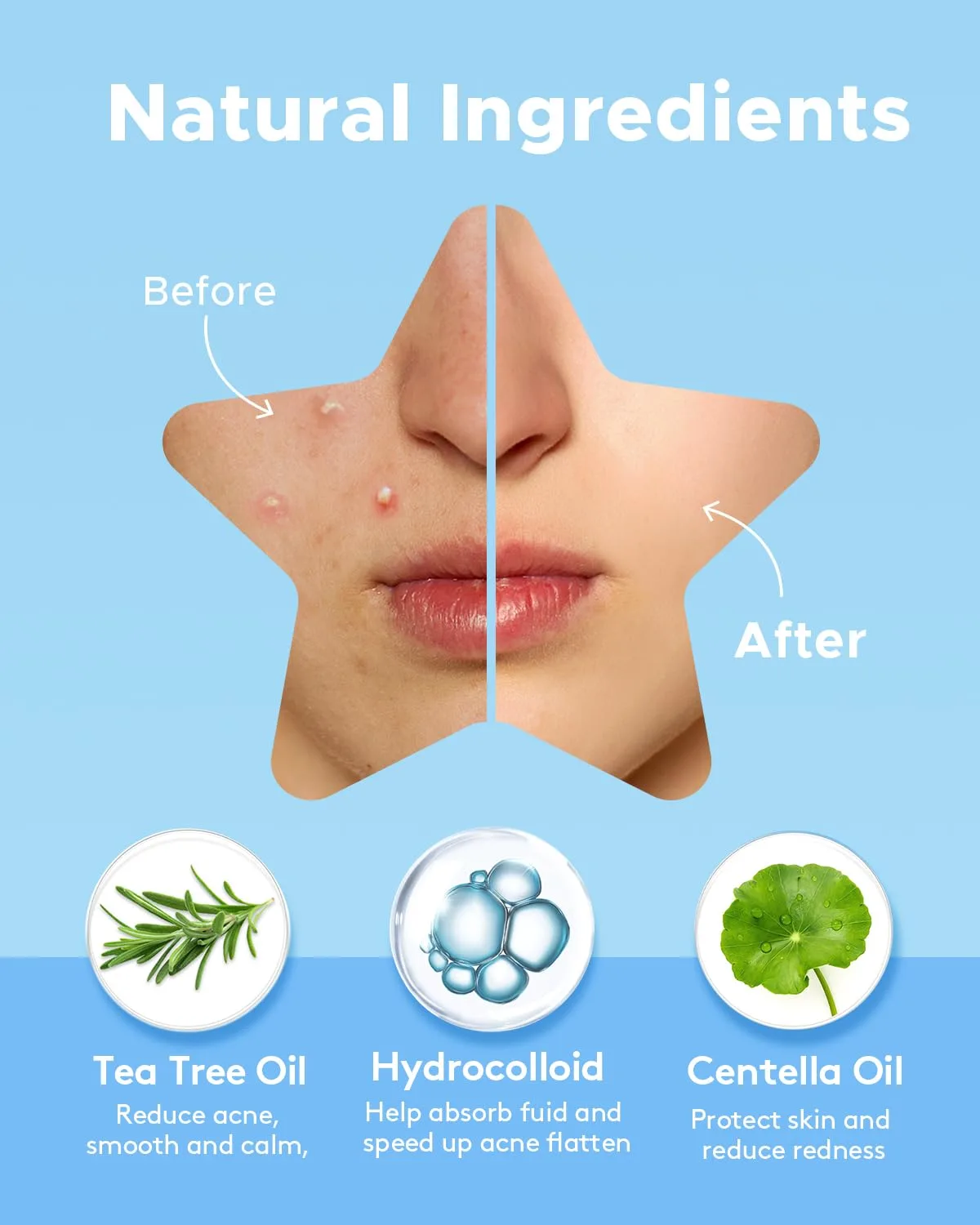 LitBear Star Pimple Patches with Case, 6 Colors 336 Dots Acne Pimple Patch with Tea Tree Oil, Hydrocolloid Acne Pimple Patches for Face Cute Zit Patches Pimple Stickers Acne Dots
