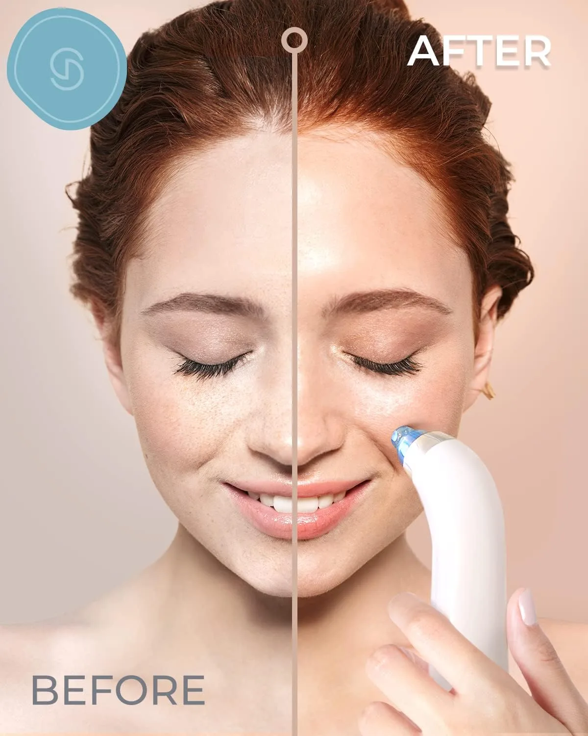 Essy Blackhead Remover Facial Cleanser Machine for Pimple Suction (Blue)
