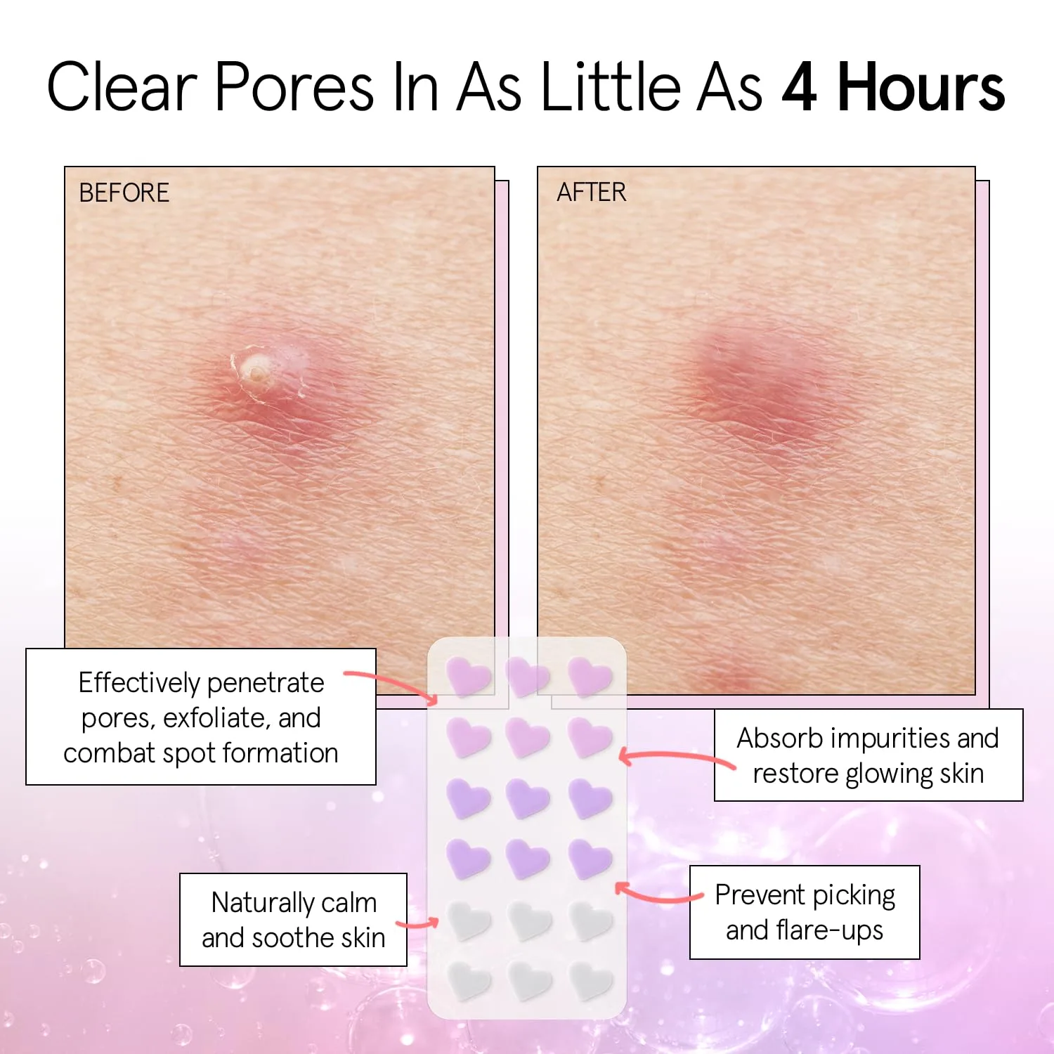 grace & stella Award Winning Pore Strip - Pimple Patches for Face