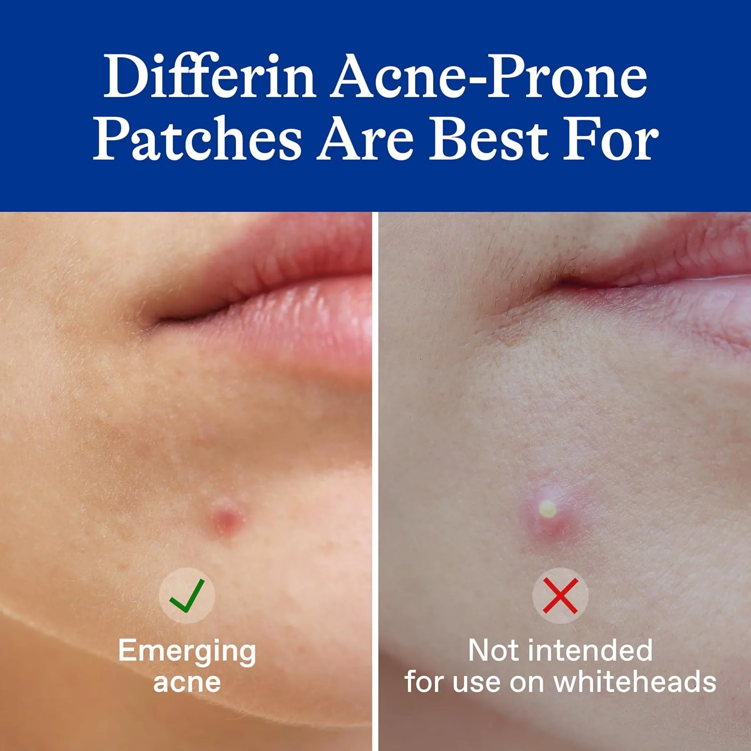 Differin Acne Treatment Pimple Patches, Salicylic Acid & Centella, 36ct