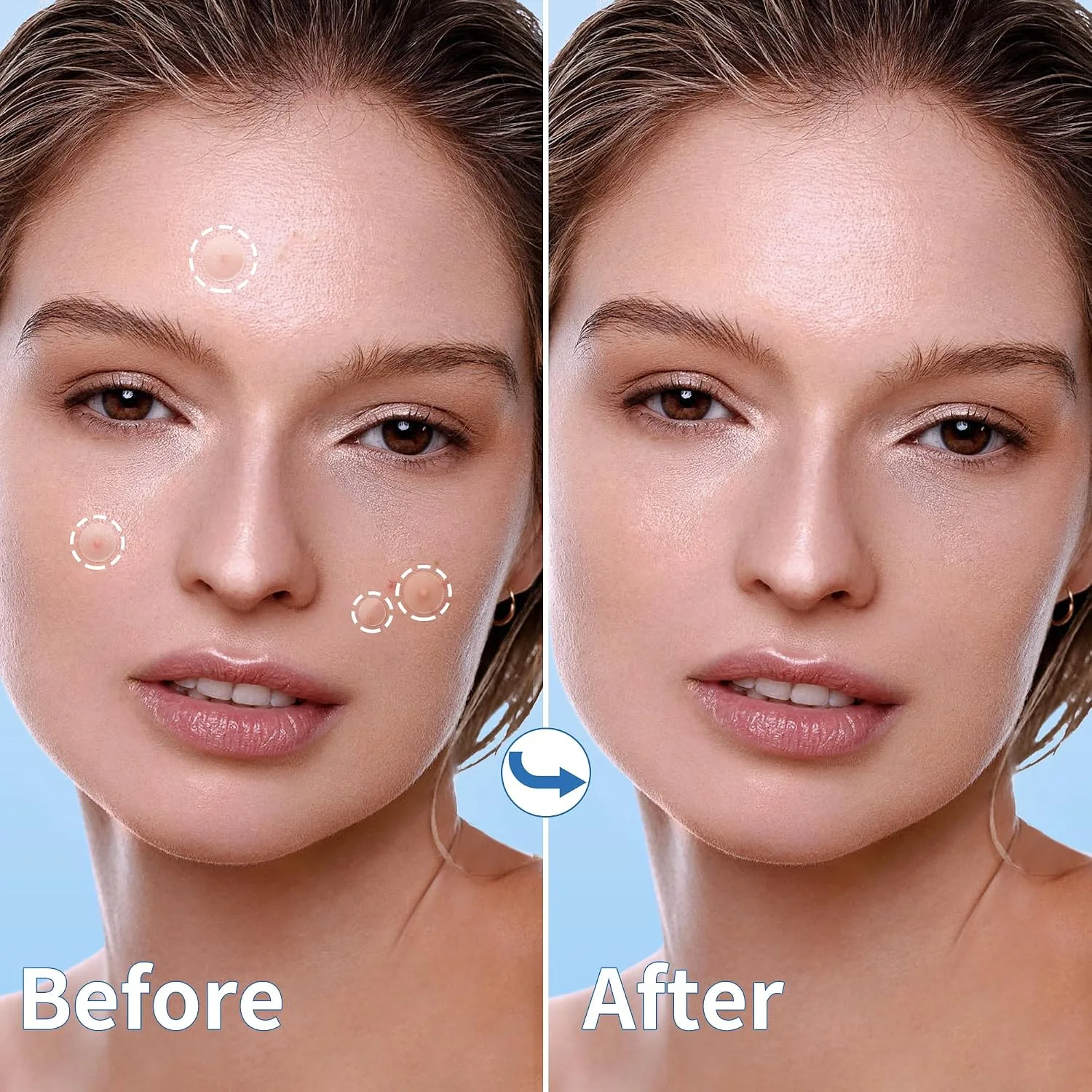 Daolyo Pimple Patches for Face, 4 Size 560 Counts Hydrocolloid Acne Patches
