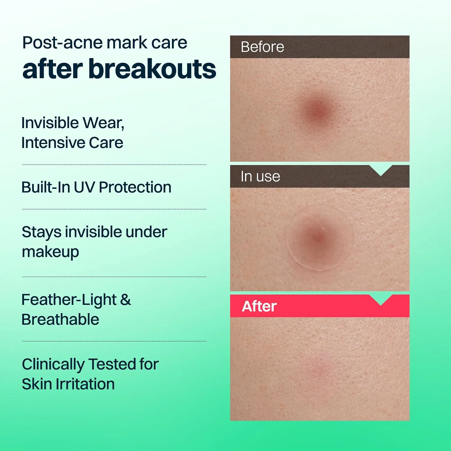 FRANZ Invisible Post-Acne Mark Patches for Dark Spots, 72 Count