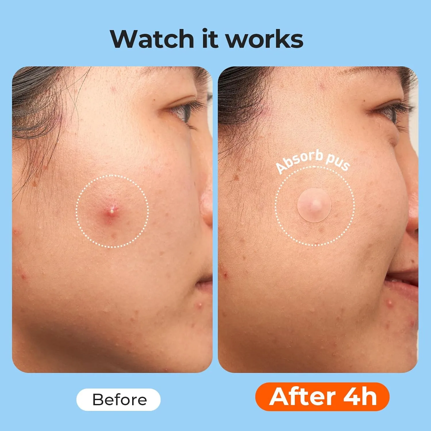 TKTK 609 Count Pimple Patches for Face, Hydrocolloid Acne Cover Patch Bulk