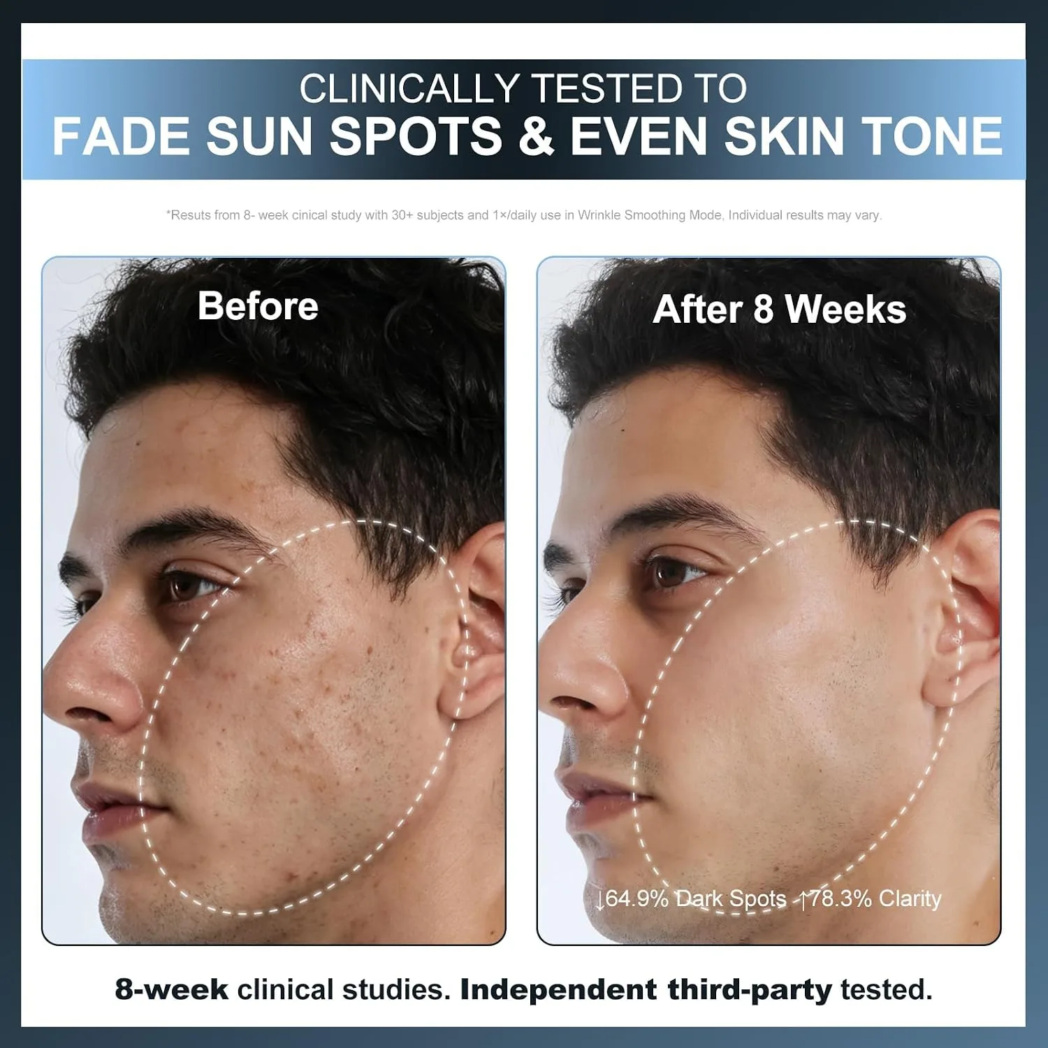 FDA Cleared 320 LEDs Red Light Therapy Mask for Face, Wireless