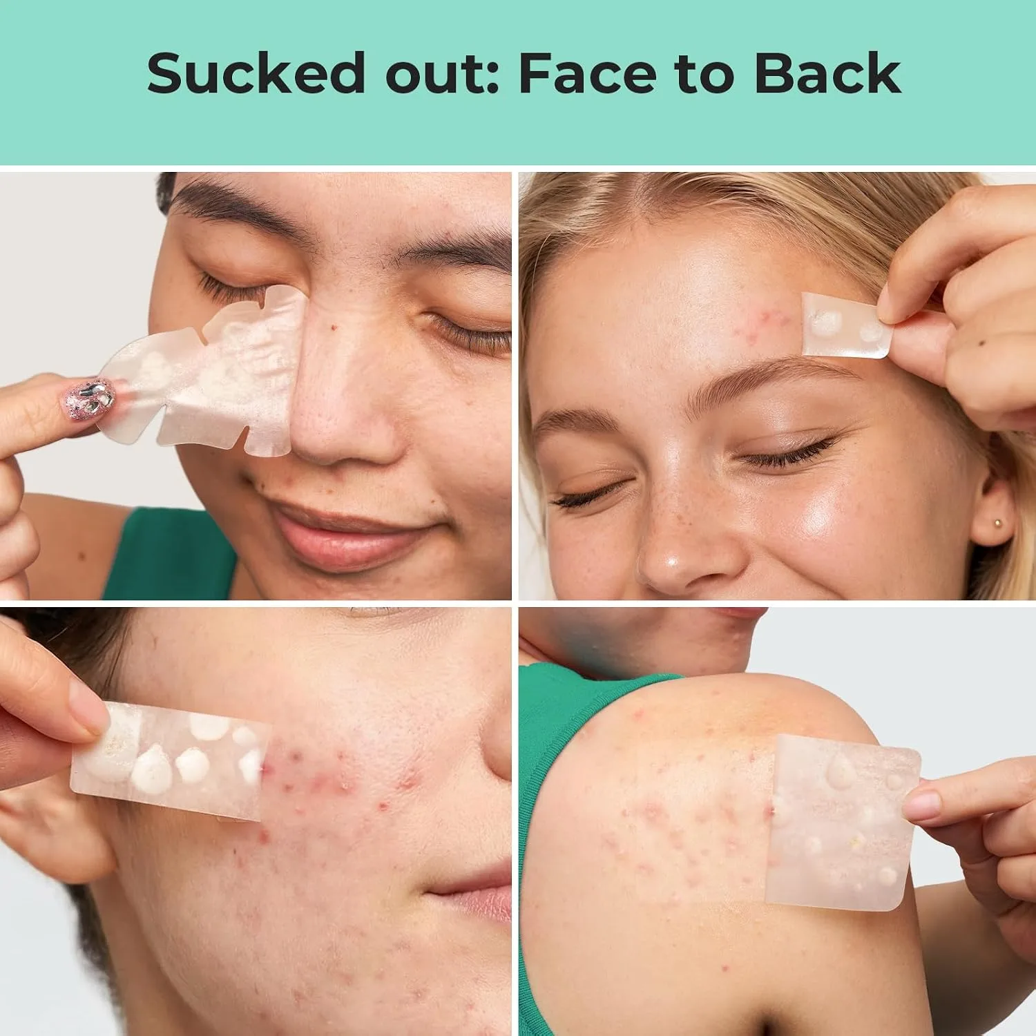 TKTK Large Hydrocolloid Pimple Patches for Acne Breakouts, 4 Big Sizes