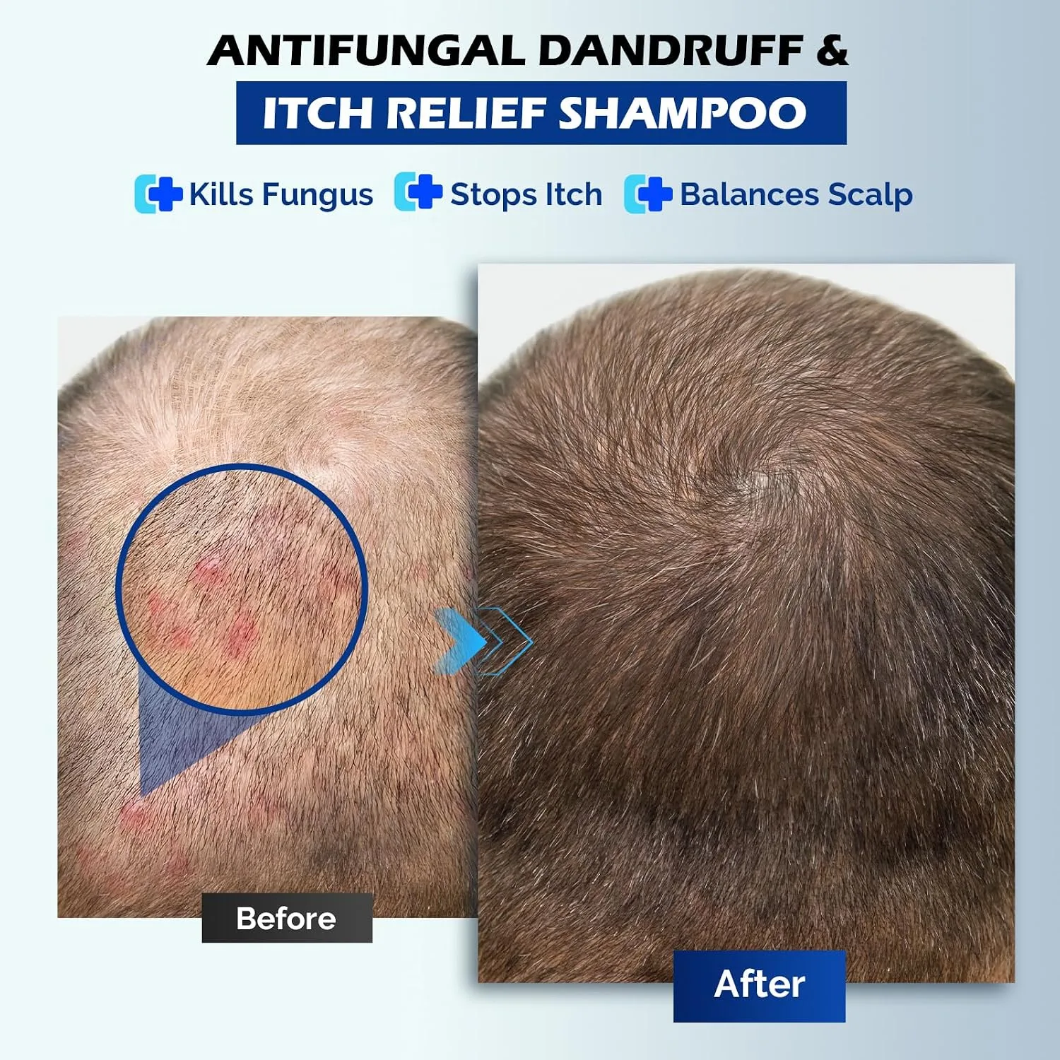oely Antifungal Shampoo for Seborrheic Dermatitis, Folliculitis - Fresh